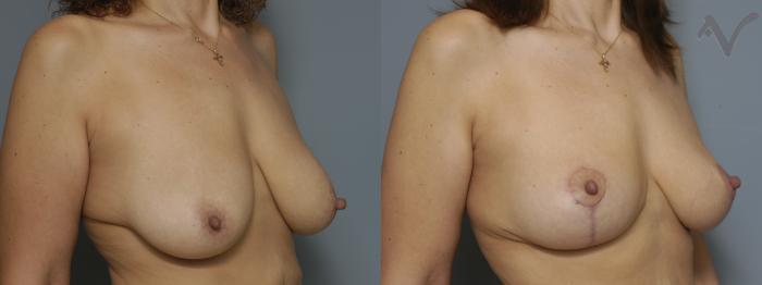 Before & After Breast Lift Case 179 Right Oblique View in Los Angeles, CA