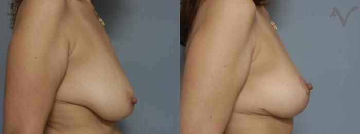 Before & After Breast Lift Case 179 Right Side View in Los Angeles, CA