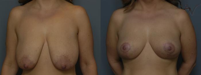 Before & After Breast Lift Case 180 Front View in Los Angeles, CA