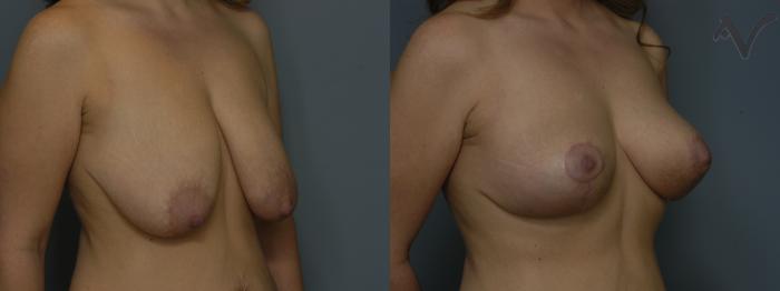 Before & After Breast Lift Case 180 Right Oblique View in Los Angeles, CA