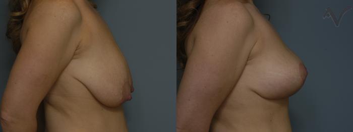 Before & After Breast Lift Case 180 Right Side View in Los Angeles, CA