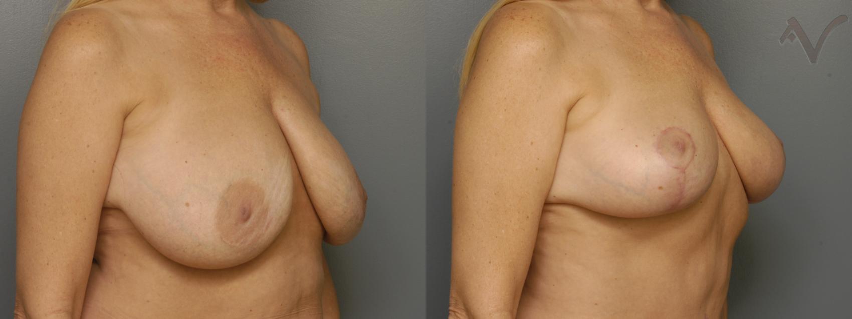 Before & After Breast Lift Case 350 Right Oblique View in Burbank, CA