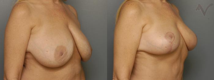 Before & After Breast Lift Case 350 Right Oblique View in Los Angeles, CA