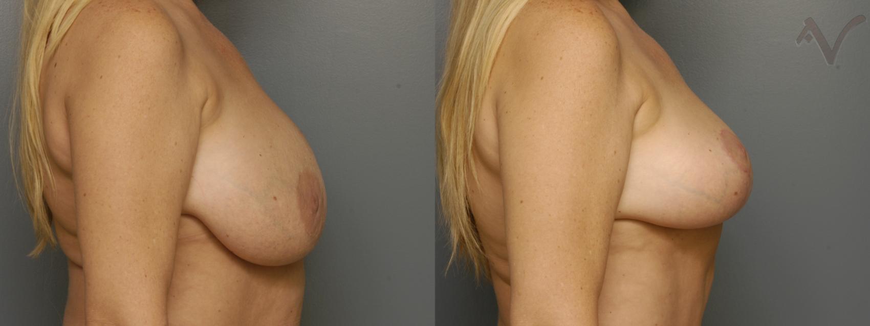 Before & After Breast Lift Case 350 Right Side View in Burbank, CA