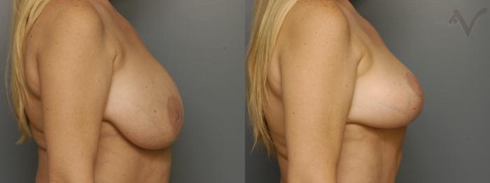 Before & After Breast Lift Case 350 Right Side View in Los Angeles, CA