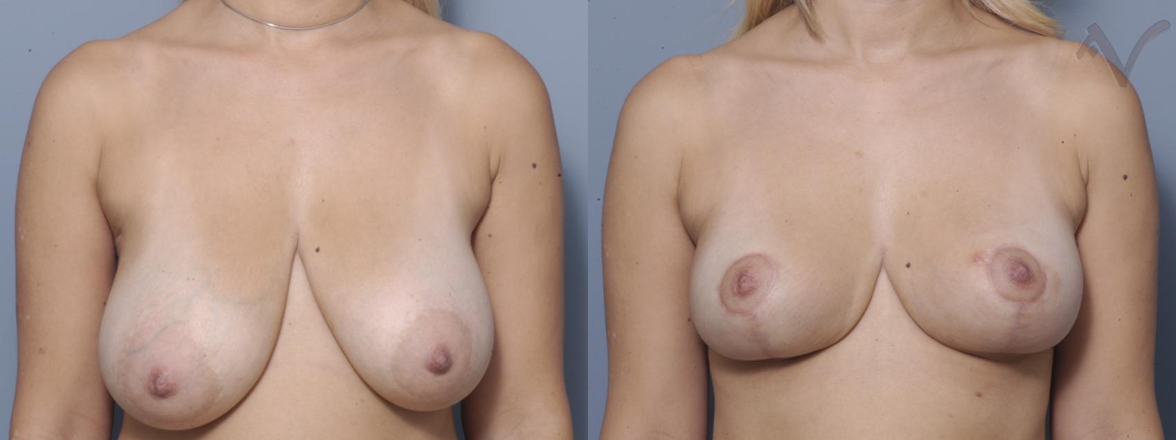 Before & After Breast Lift Case 351 Front View in Los Angeles, CA