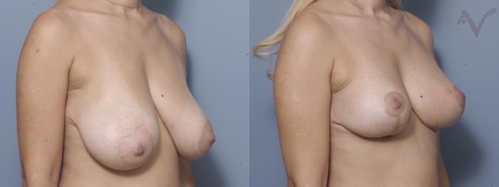 Before & After Breast Lift Case 351 Right Oblique View in Los Angeles, CA