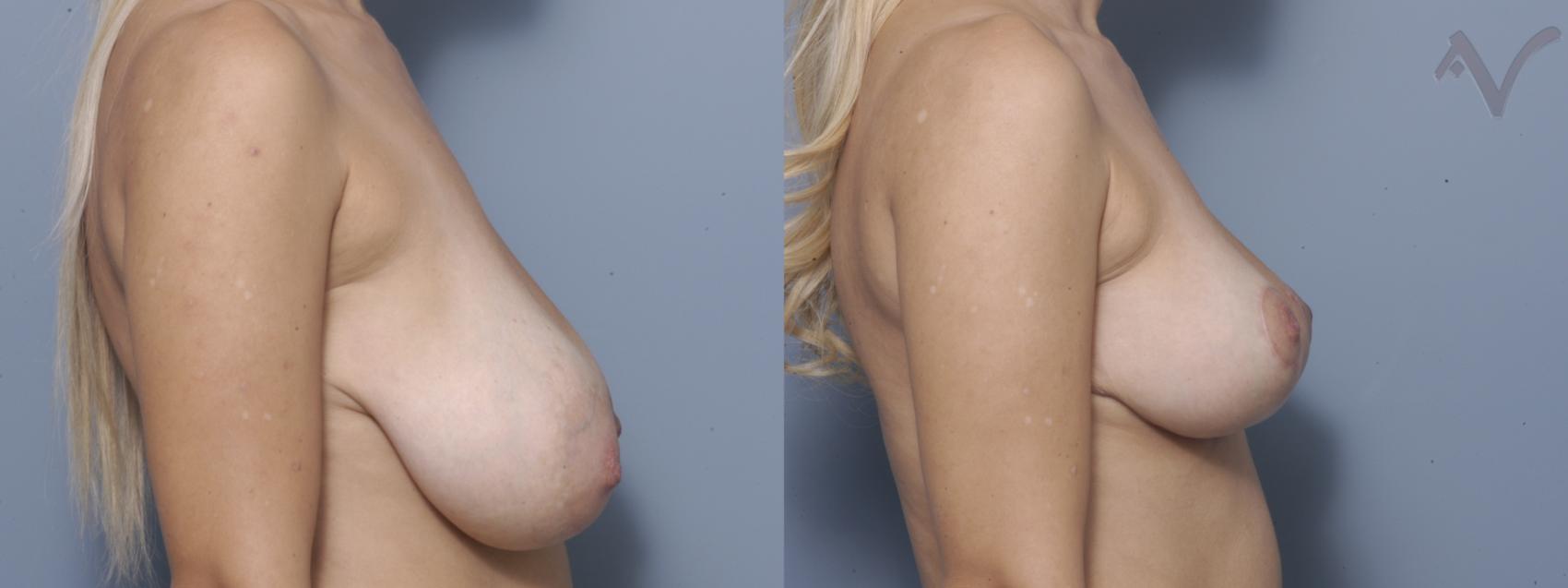 Before & After Breast Lift Case 351 Right Side View in Los Angeles, CA