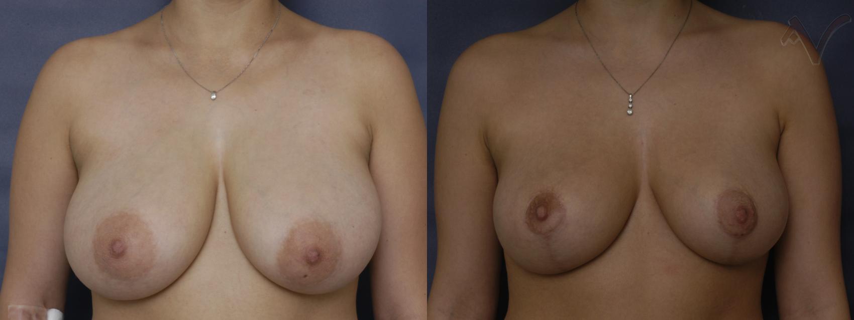 Before & After Breast Reduction Case 123 Front View in Burbank, CA