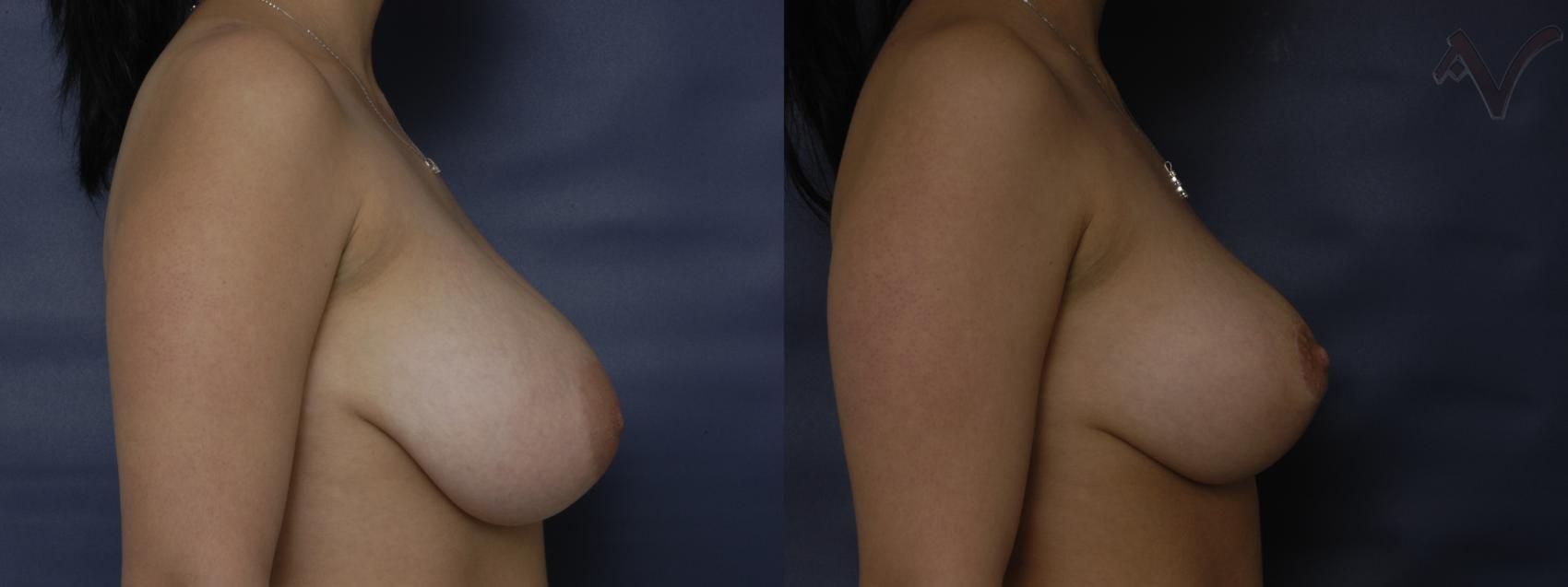 Before & After Breast Reduction Case 123 Right Side View in Burbank, CA