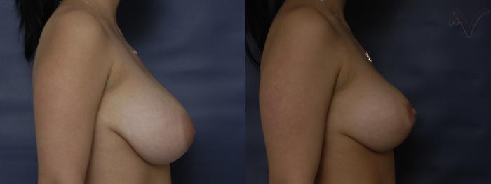 Before & After Breast Reduction Case 123 Right Side View in Los Angeles, CA