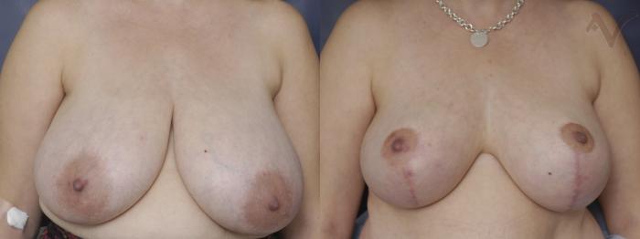 Before & After Breast Reduction Case 124 Front View in Los Angeles, CA