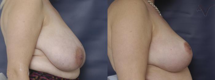 Before & After Breast Reduction Case 124 Right Side View in Los Angeles, CA