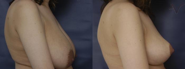 Before & After Breast Reduction Case 125 Right Side View in Los Angeles, CA