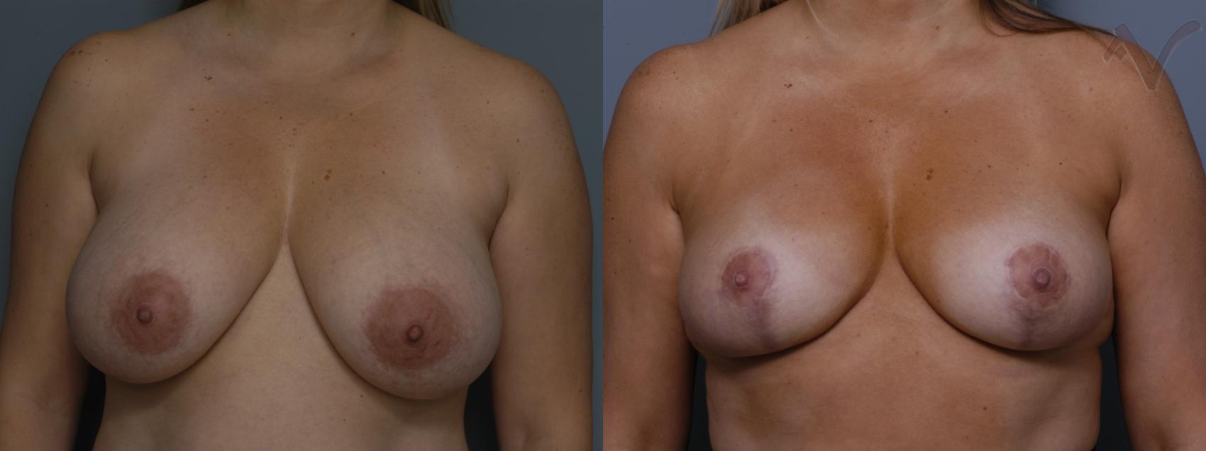 Before & After Breast Reduction Case 128 Front View in Burbank, CA
