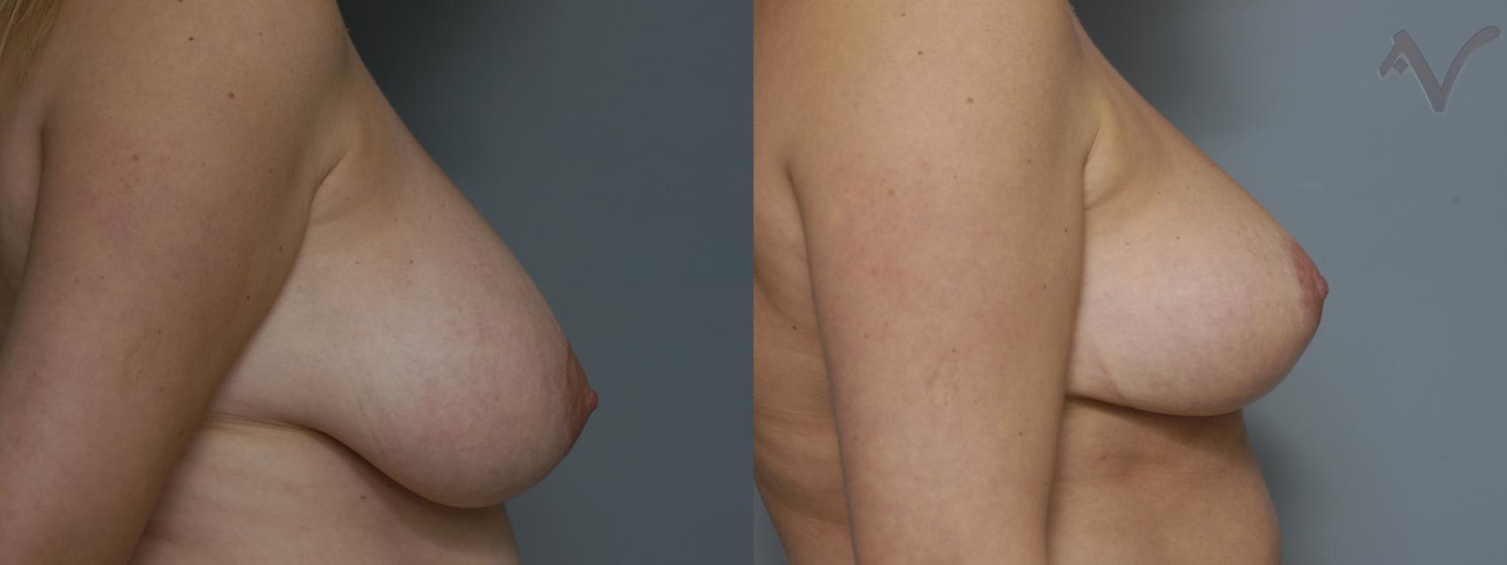Before & After Breast Reduction Case 128 Right Side View in Burbank, CA