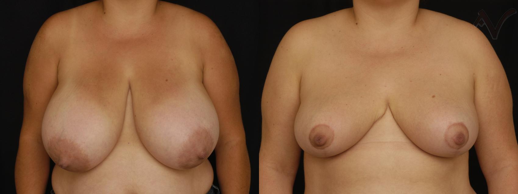 Before & After Breast Reduction Case 130 Front View in Los Angeles, CA