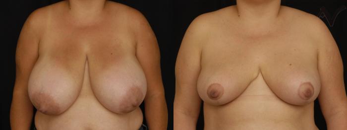 Before & After Breast Reduction Case 130 Front View in Los Angeles, CA