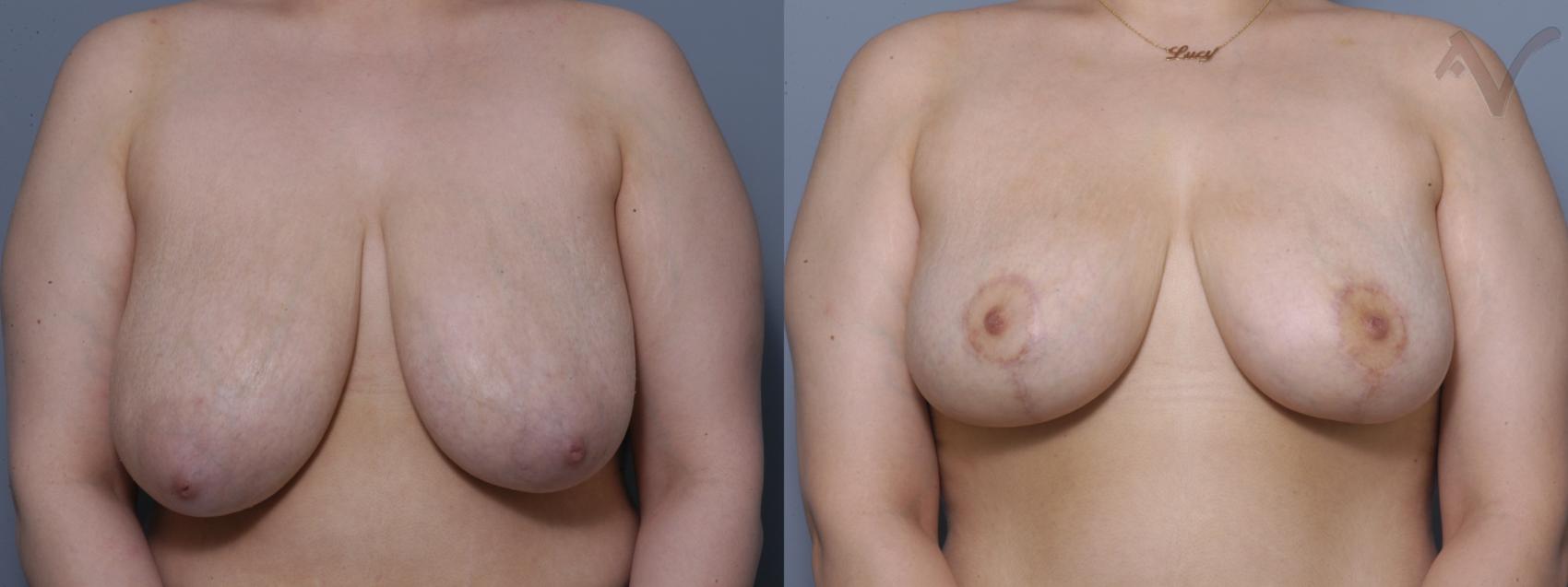 Before & After Breast Reduction Case 138 Front View in Los Angeles, CA