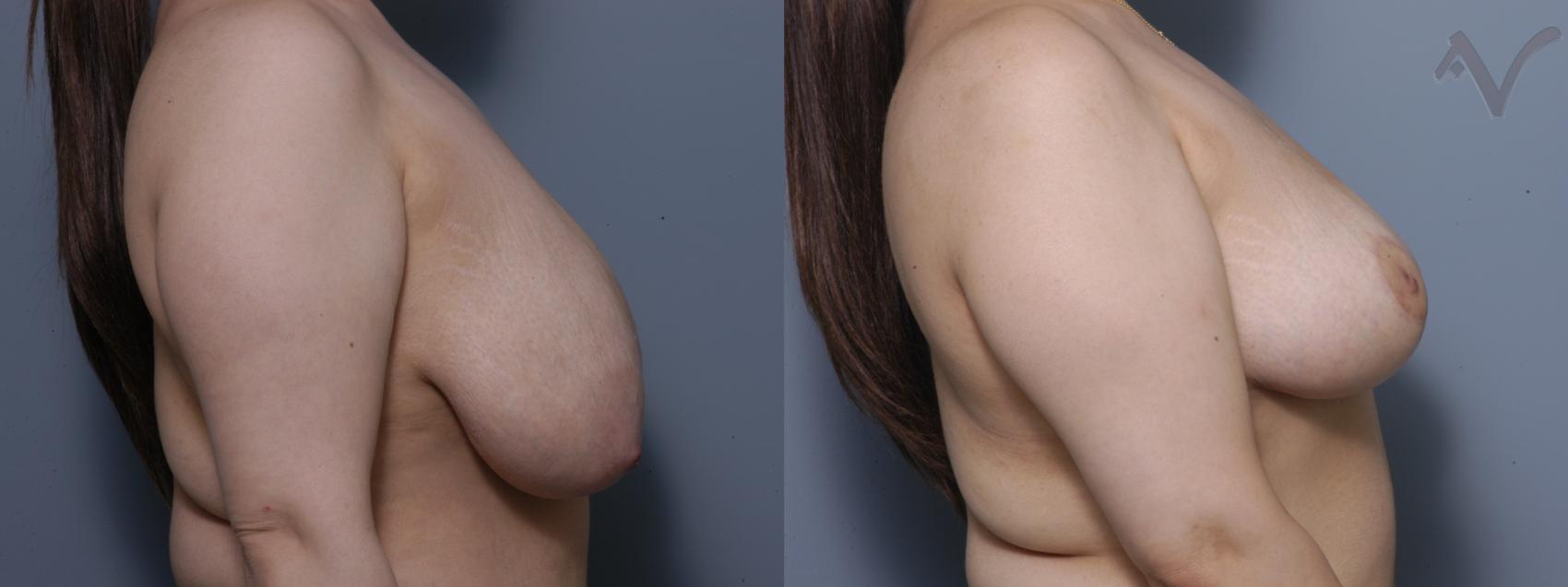 Before & After Breast Reduction Case 138 Right Side View in Burbank, CA