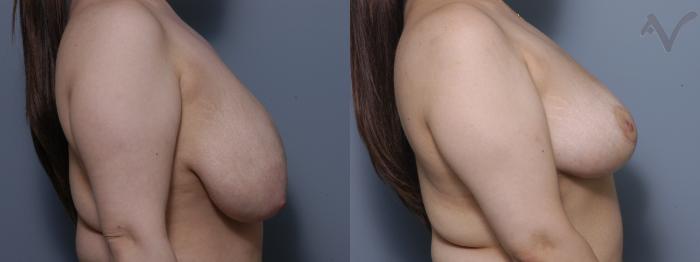 Before & After Breast Reduction Case 138 Right Side View in Los Angeles, CA