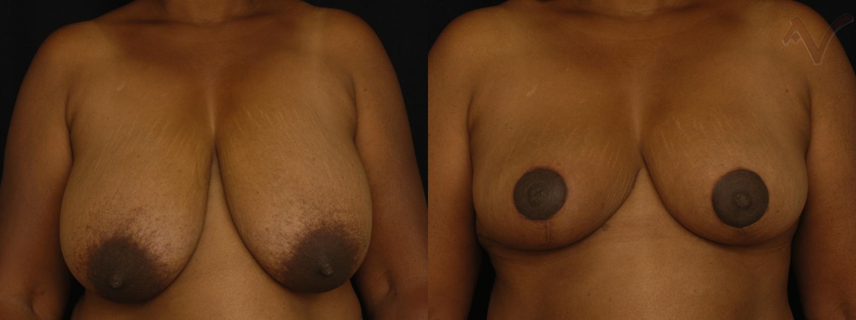 Before & After Breast Reduction Case 144 Front View in Burbank, CA