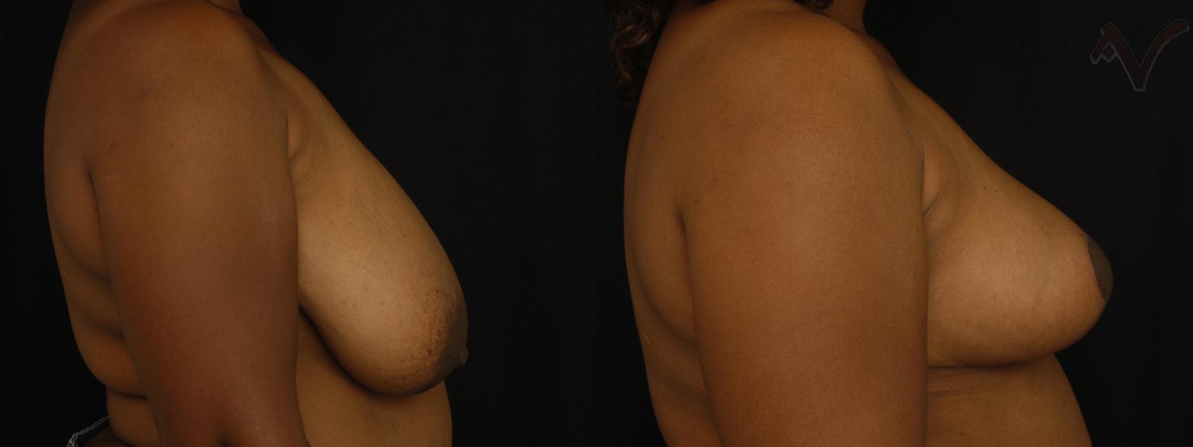 Before & After Breast Reduction Case 144 Right Side View in Burbank, CA