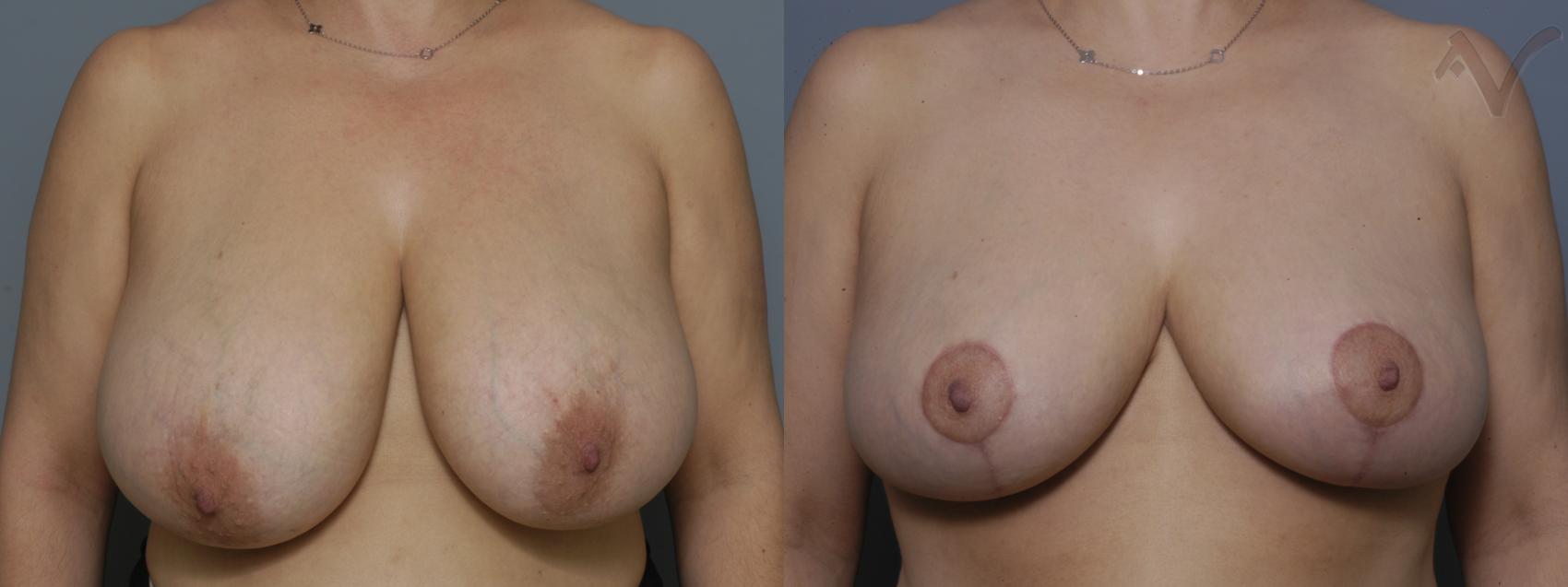 Before & After Breast Reduction Case 146 Front View in Burbank, CA