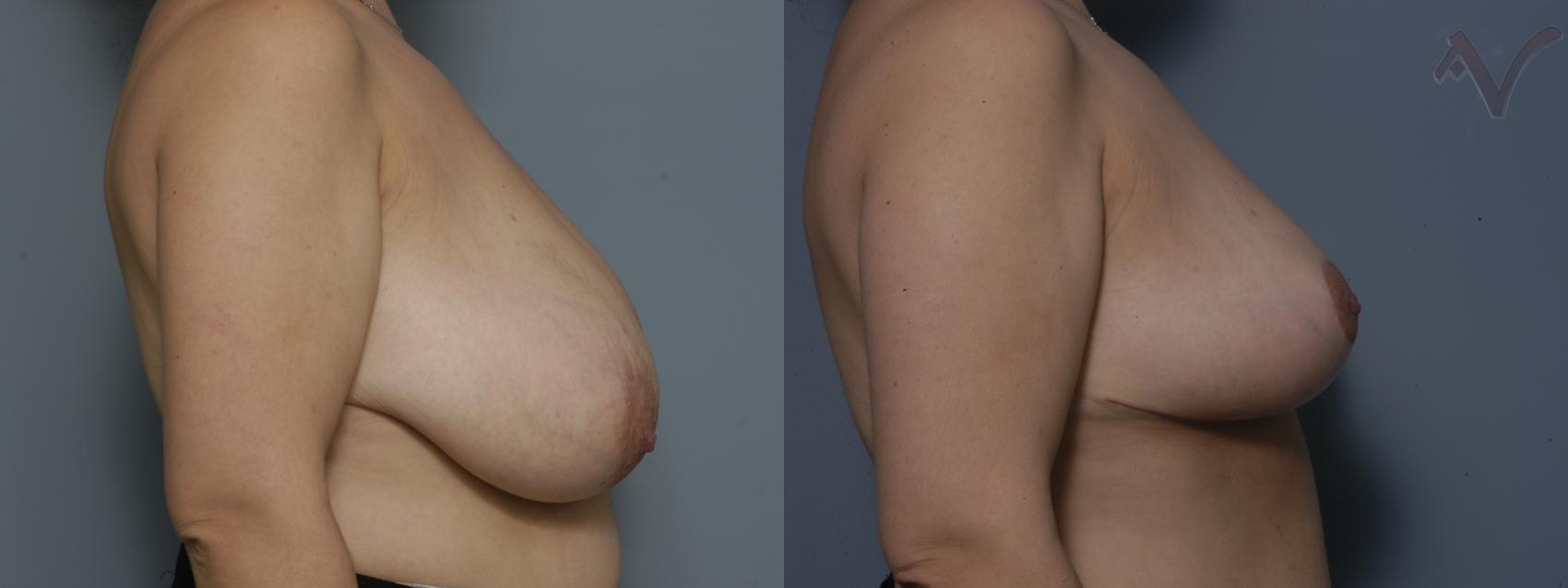 Before & After Breast Reduction Case 146 Right Side View in Burbank, CA