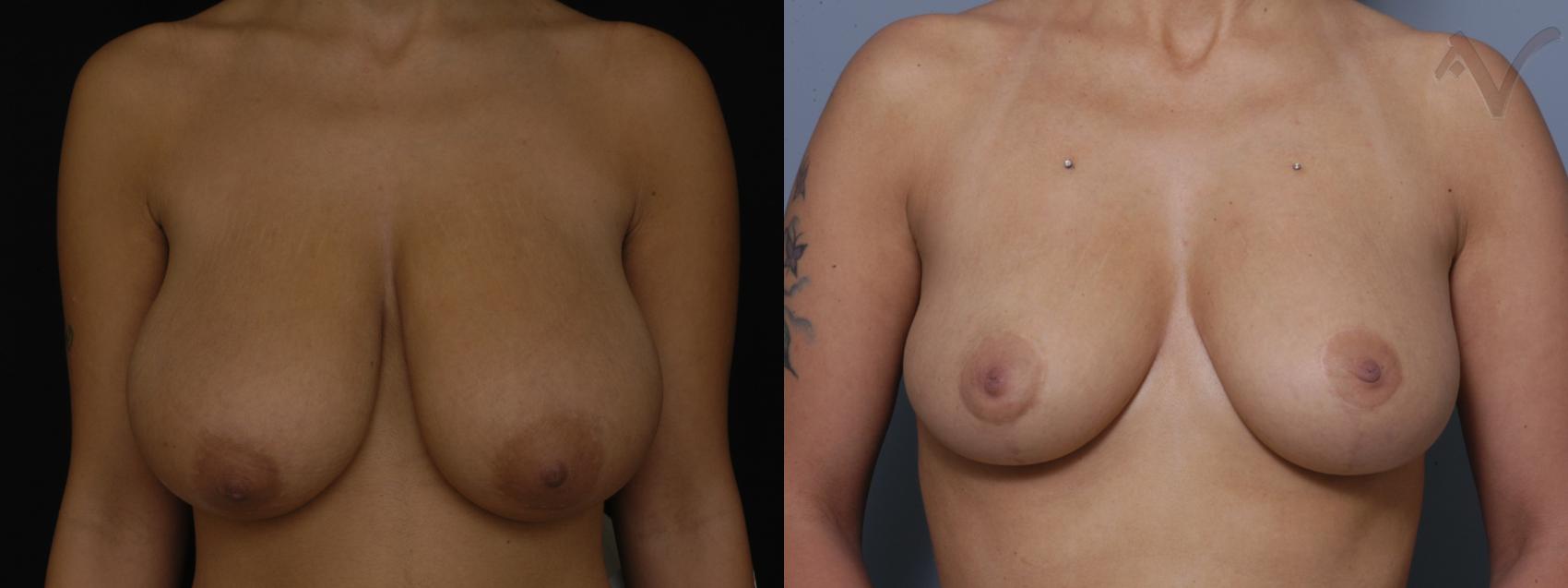 Before & After Breast Reduction Case 149 Front View in Burbank, CA