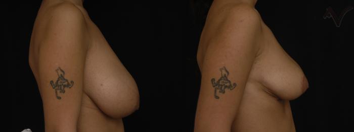 Before & After Breast Reduction Case 149 Right Side View in Los Angeles, CA