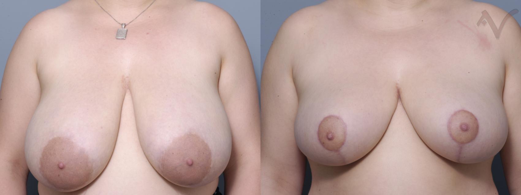 Before & After Breast Reduction Case 150 Front View in Los Angeles, CA
