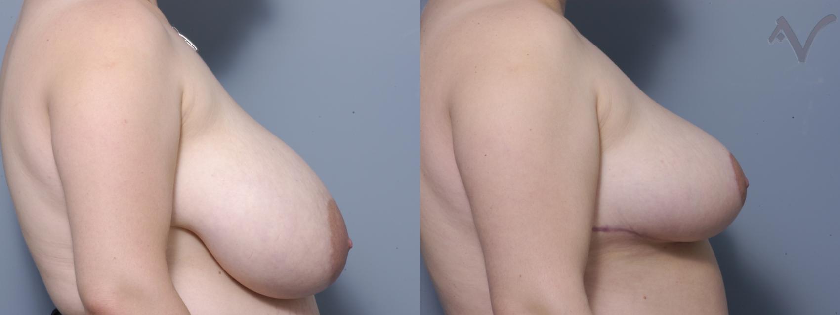 Before & After Breast Reduction Case 150 Right Side View in Burbank, CA