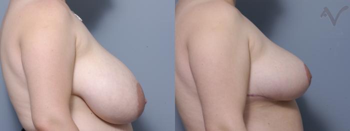 Before & After Breast Reduction Case 150 Right Side View in Los Angeles, CA