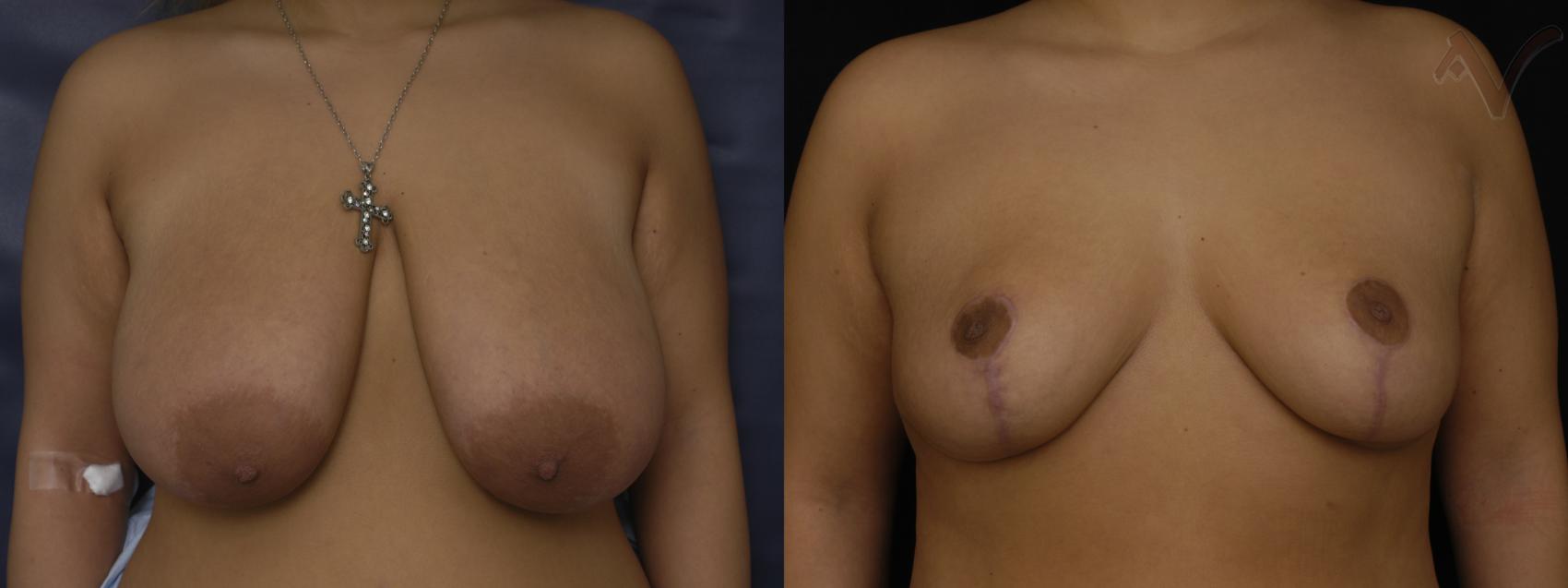 Before & After Breast Reduction Case 151 Front View in Burbank, CA