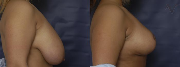 Before & After Breast Reduction Case 151 Right Side View in Los Angeles, CA
