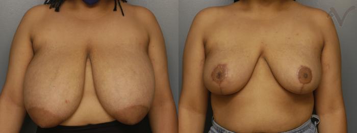 Before & After Breast Reduction Case 338 Front View in Los Angeles, CA