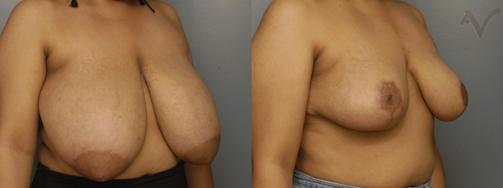 Before & After Breast Reduction Case 338 Right Oblique View in Los Angeles, CA