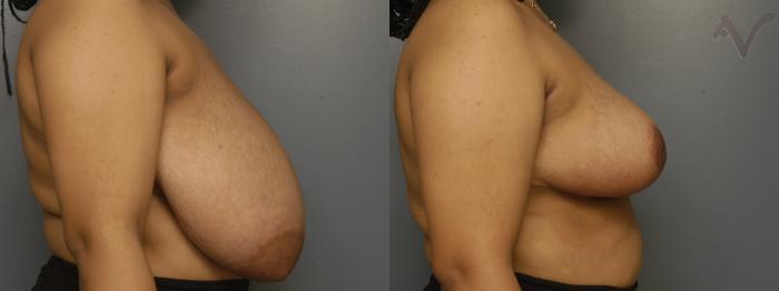 Before & After Breast Reduction Case 338 Right Side View in Los Angeles, CA