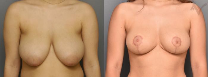 Before & After Breast Reduction Case 352 Front View in Los Angeles, CA