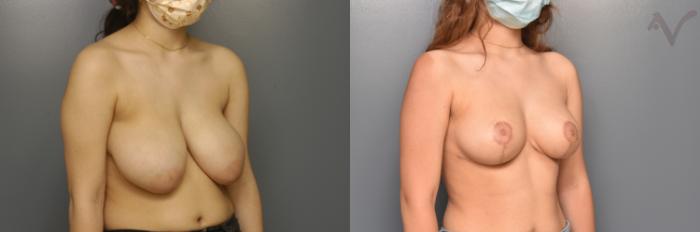 Before & After Breast Reduction Case 352 Right Oblique View in Los Angeles, CA