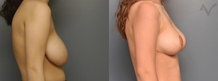 Before & After Breast Reduction Case 352 Right Side View in Los Angeles, CA