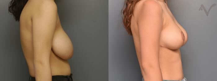 Before & After Breast Reduction Case 364 Right Side View in Los Angeles, CA