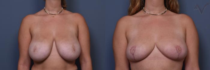 Before & After Breast Reduction Case 398 Front View in Los Angeles, CA
