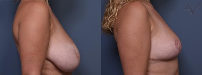 Before & After Breast Reduction Case 398 Right Side View in Los Angeles, CA