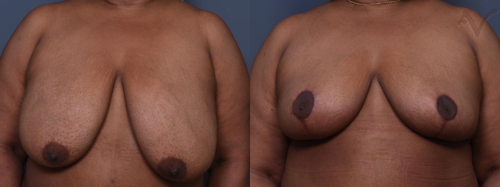 Before & After Breast Reduction Case 400 Front View in Los Angeles, CA