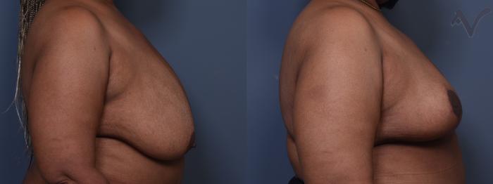 Before & After Breast Reduction Case 400 Right Side View in Los Angeles, CA
