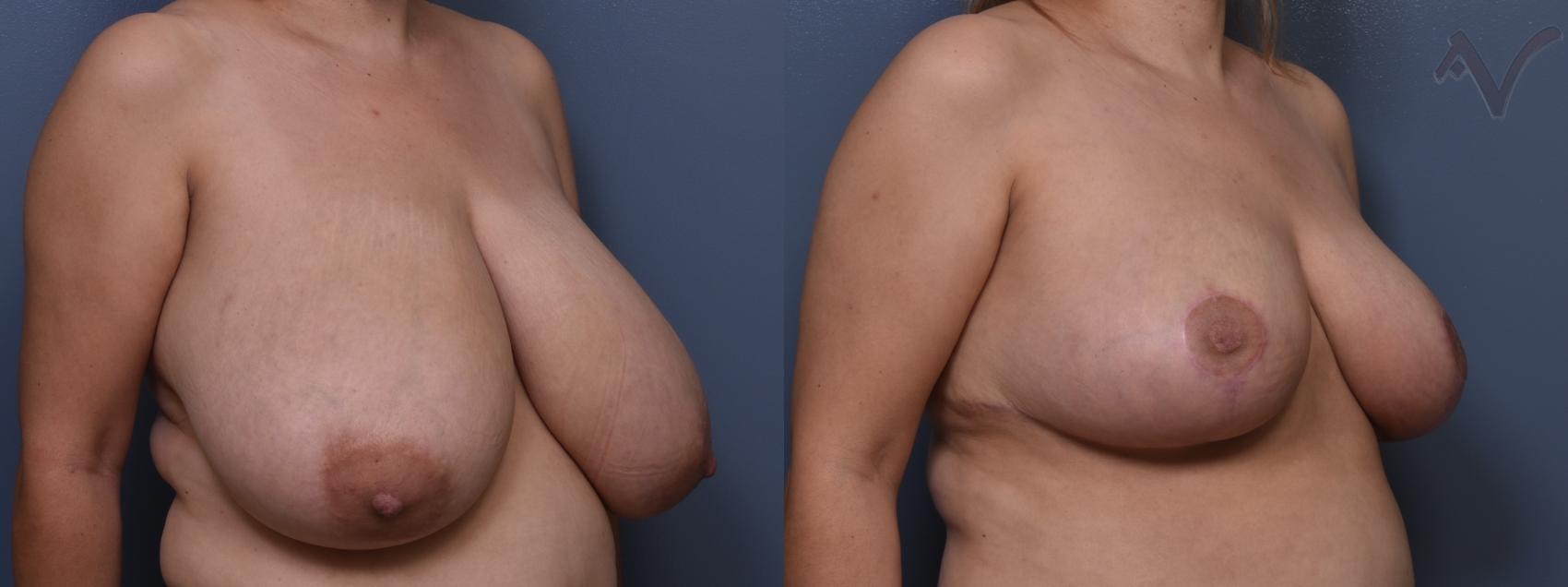 Before & After Breast Reduction Case 454 Right Oblique View in Los Angeles, CA