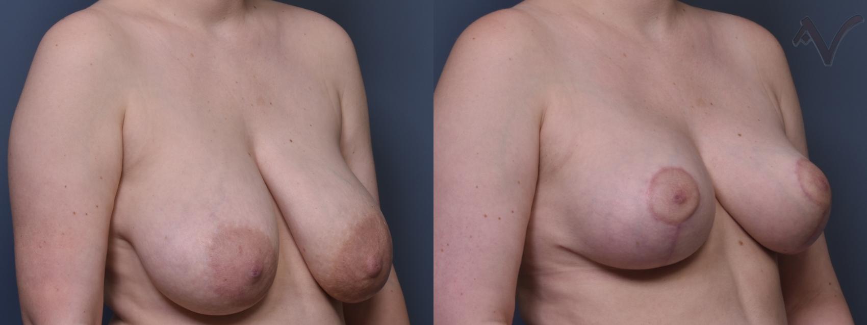 Before & After Breast Reduction Case 455 Right Oblique View in Los Angeles, CA
