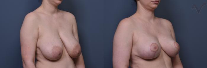 Before & After Breast Reduction Case 455 Right Oblique View in Los Angeles, CA